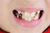 Les types d’occlusion dentaire