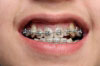 Le traitement orthodontique des adultes